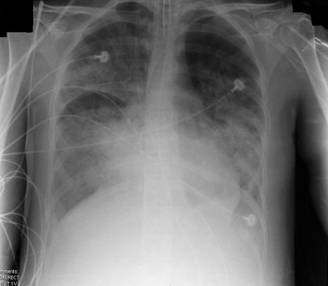 X-ray of acute respiratory distress syndrome (ARDS) patient. (Photo: public domain)