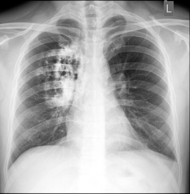 X-ray of lung cancer patient. (Photo: Shutterstock)