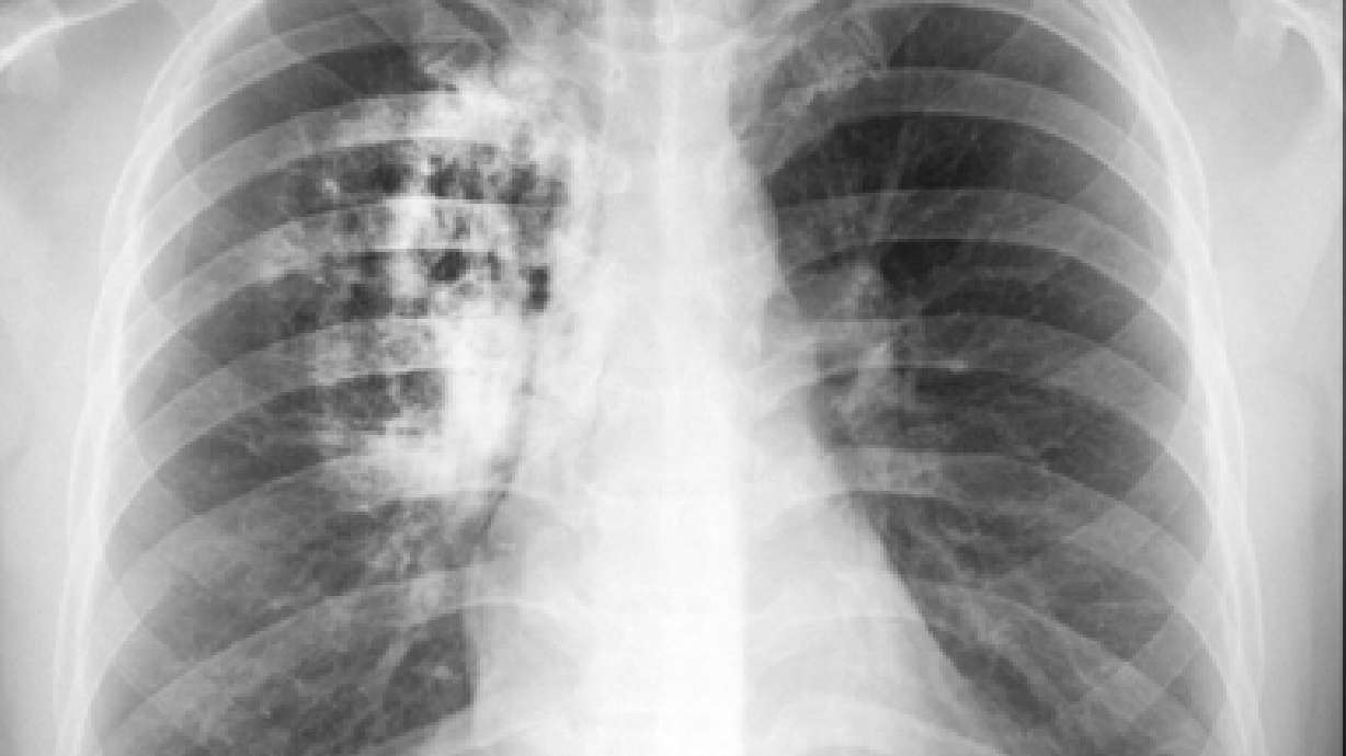 Baja incidencia de cáncer pulmonar, más en hombres