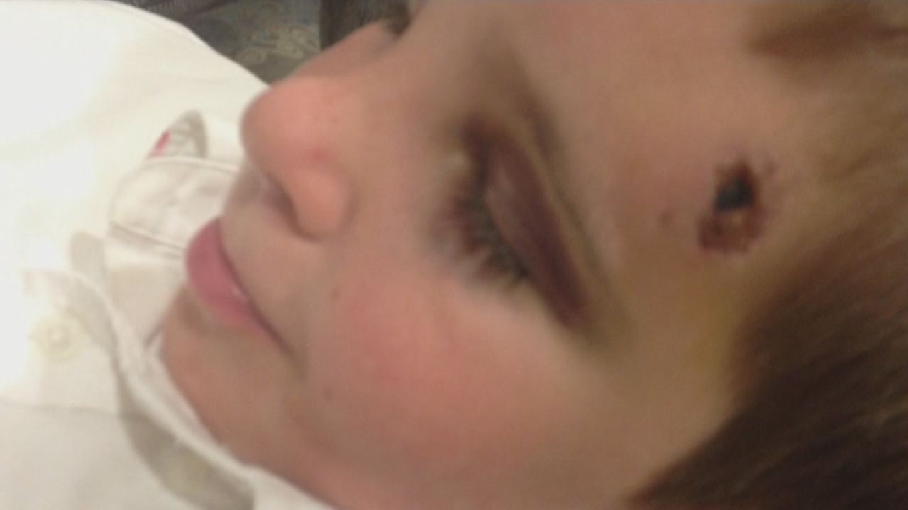 Photo of the injuries Timothy Anaya sustained 
on May 2, 2013, when he was hit by a golf ball 
while playing on his school playground. (Photo: 
Anaya family)