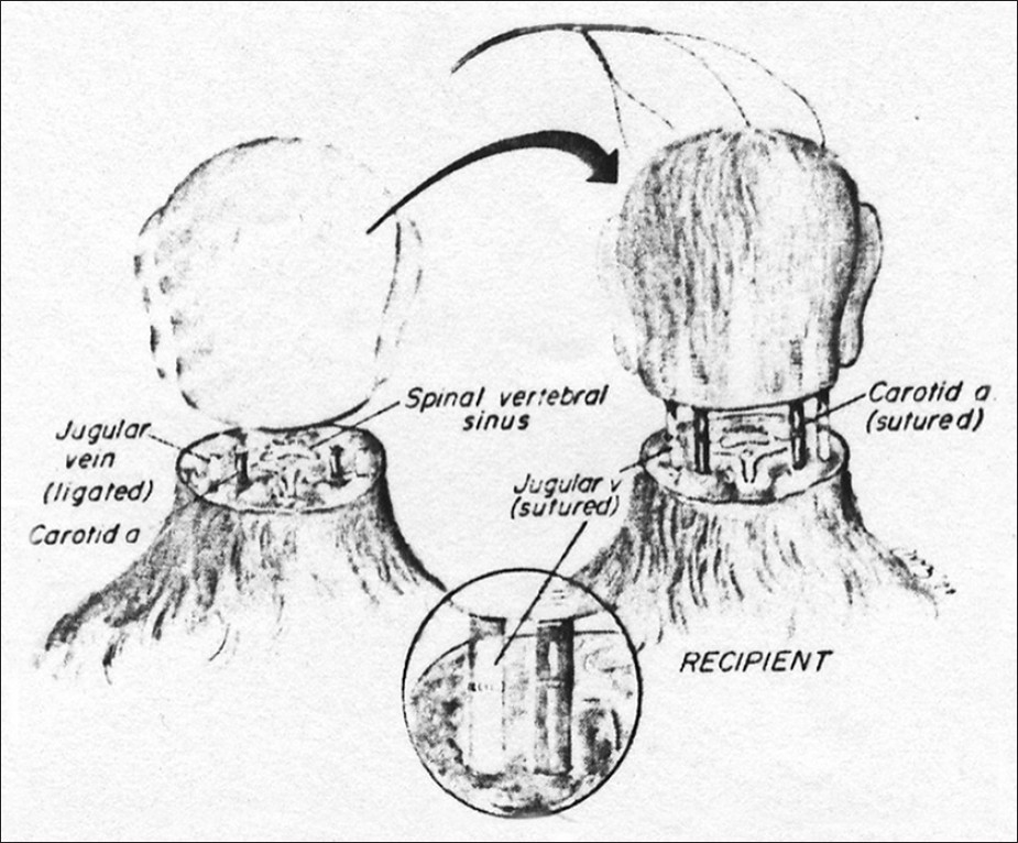 Human head transplants now possible, says Italian scientist
