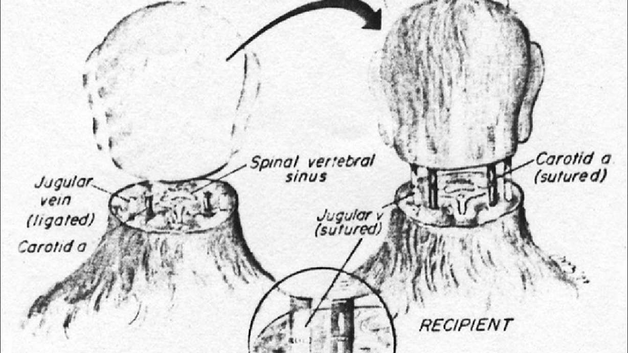 Human head transplants now possible, says Italian scientist
