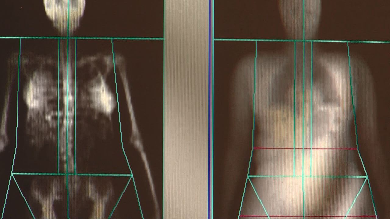 Stagnant weight loss? Bone density scan could help ID problem