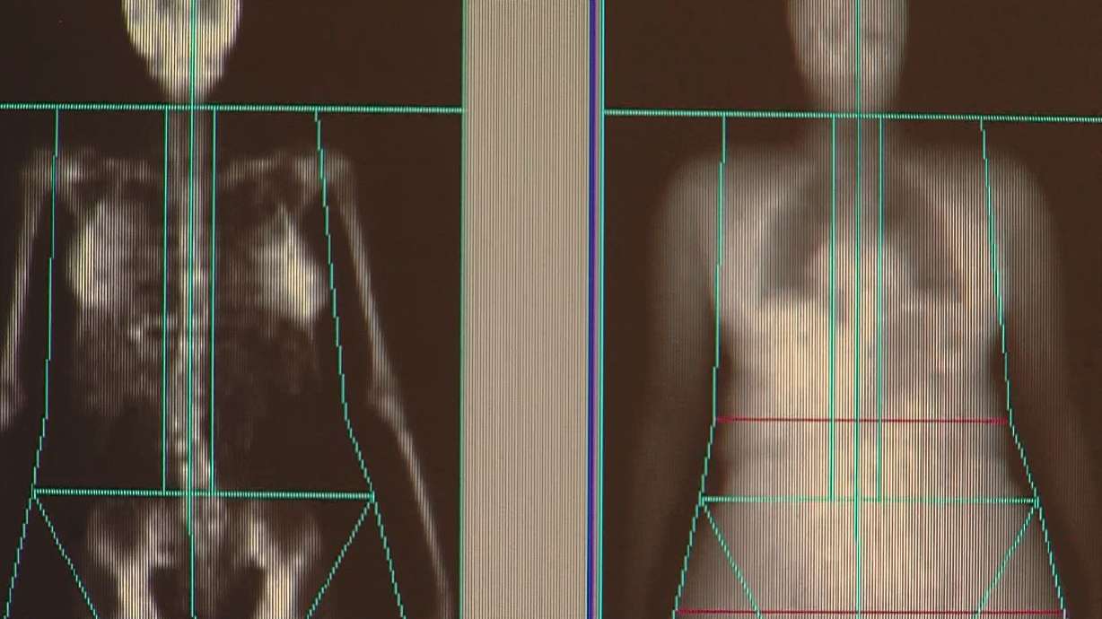 Stagnant weight loss? Bone density scan could help ID problem