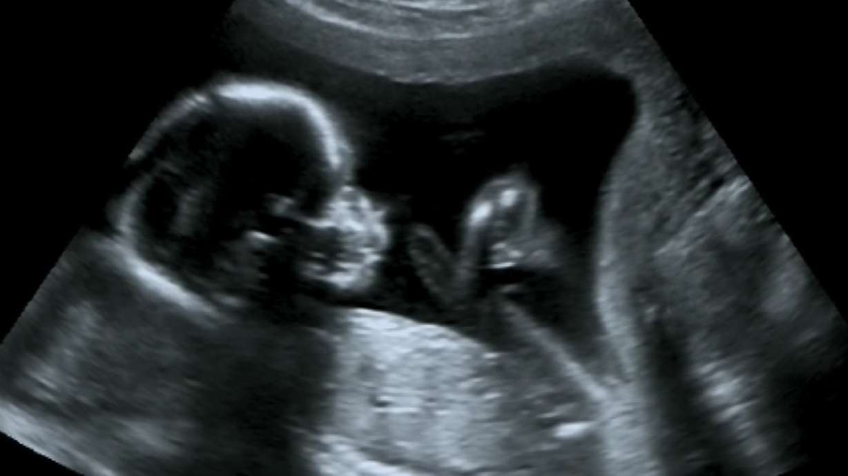 Abortion policy and disputed science: How soon do fetuses feel pain?
