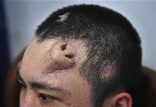 In this Tuesday Sept. 24, 2013 photo, a 22-
year-old patient, with a surgical made extra 
nose out of his rib cartilage and implanted 
under the skin of his forehead, rests. (AP 
Photo)