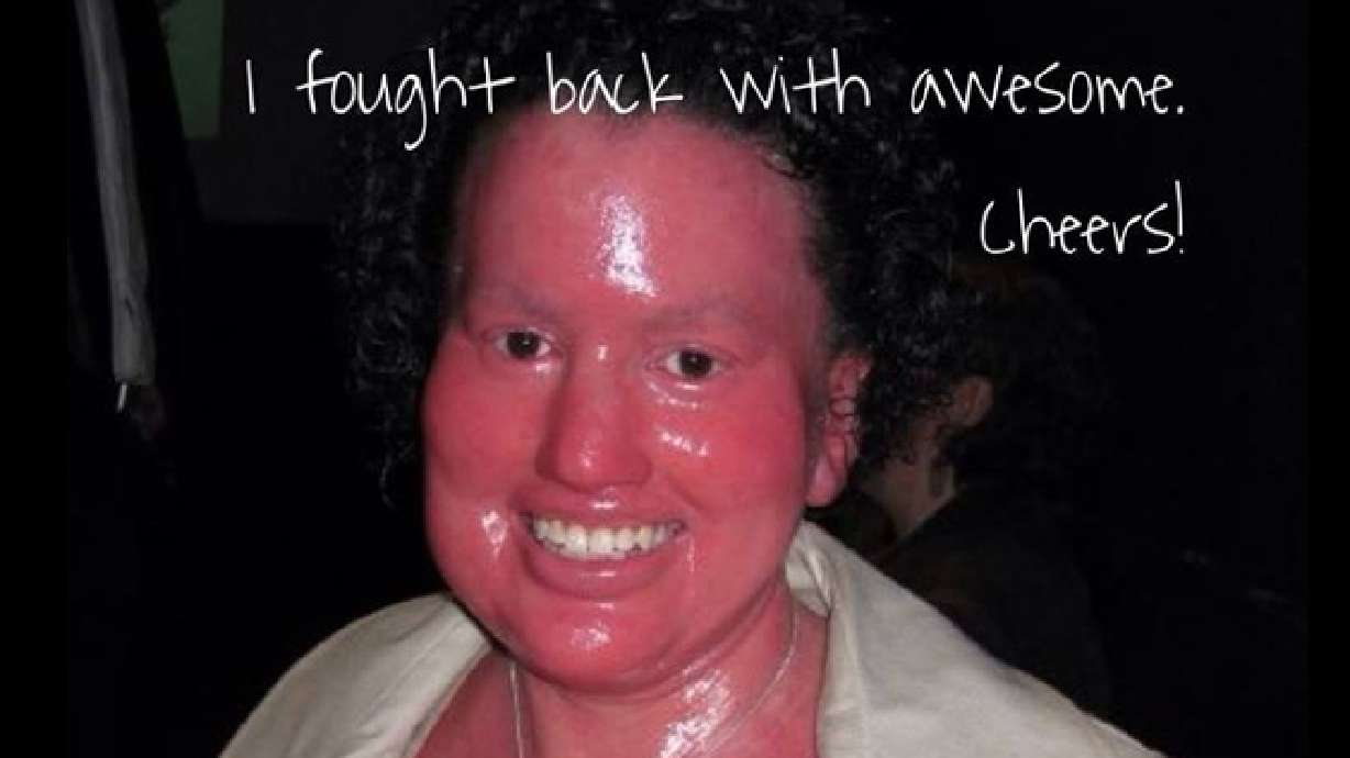 Woman with skin condition faces down Web bullies with a simple message