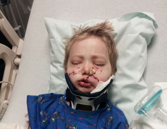 6-year-old boy hospitalized after dog attack