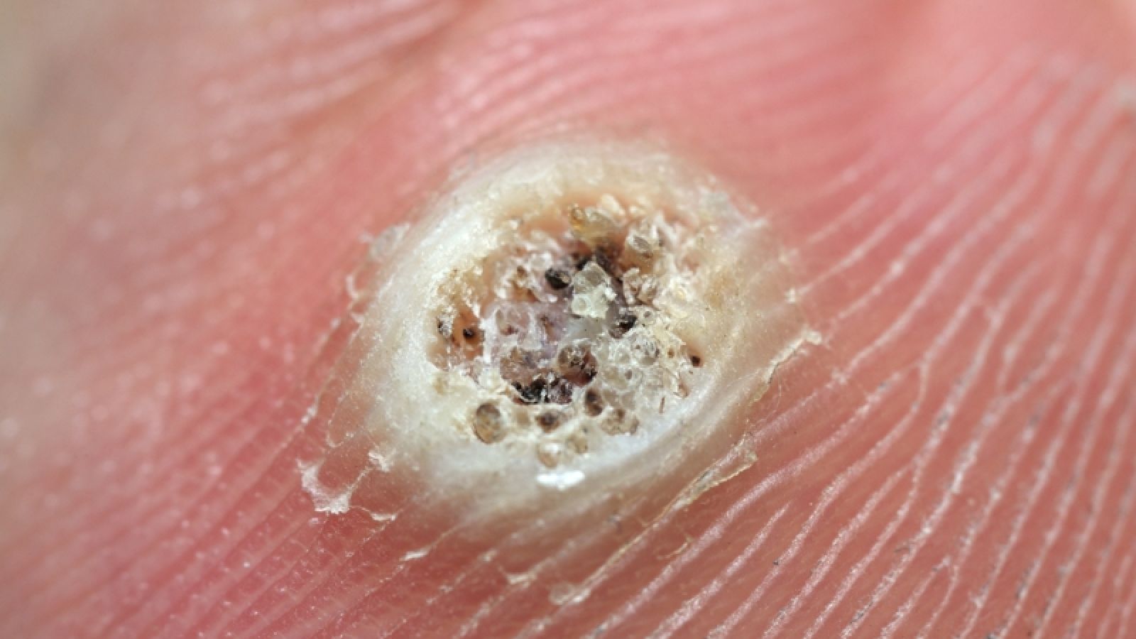 Tips On Identifying And Destroying Annoying Warts Ksl Com Tips On Identifying And Destroying Annoying Warts Ksl Com