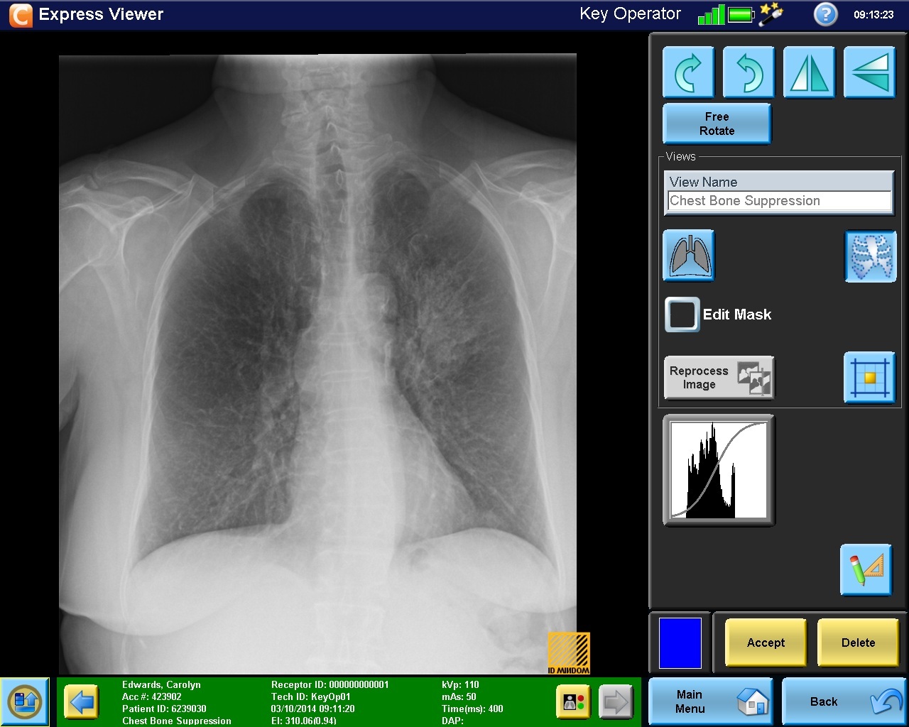 Carestream’s New Bone Suppression Software Receives FDA Clearance, Now Available Worldwide