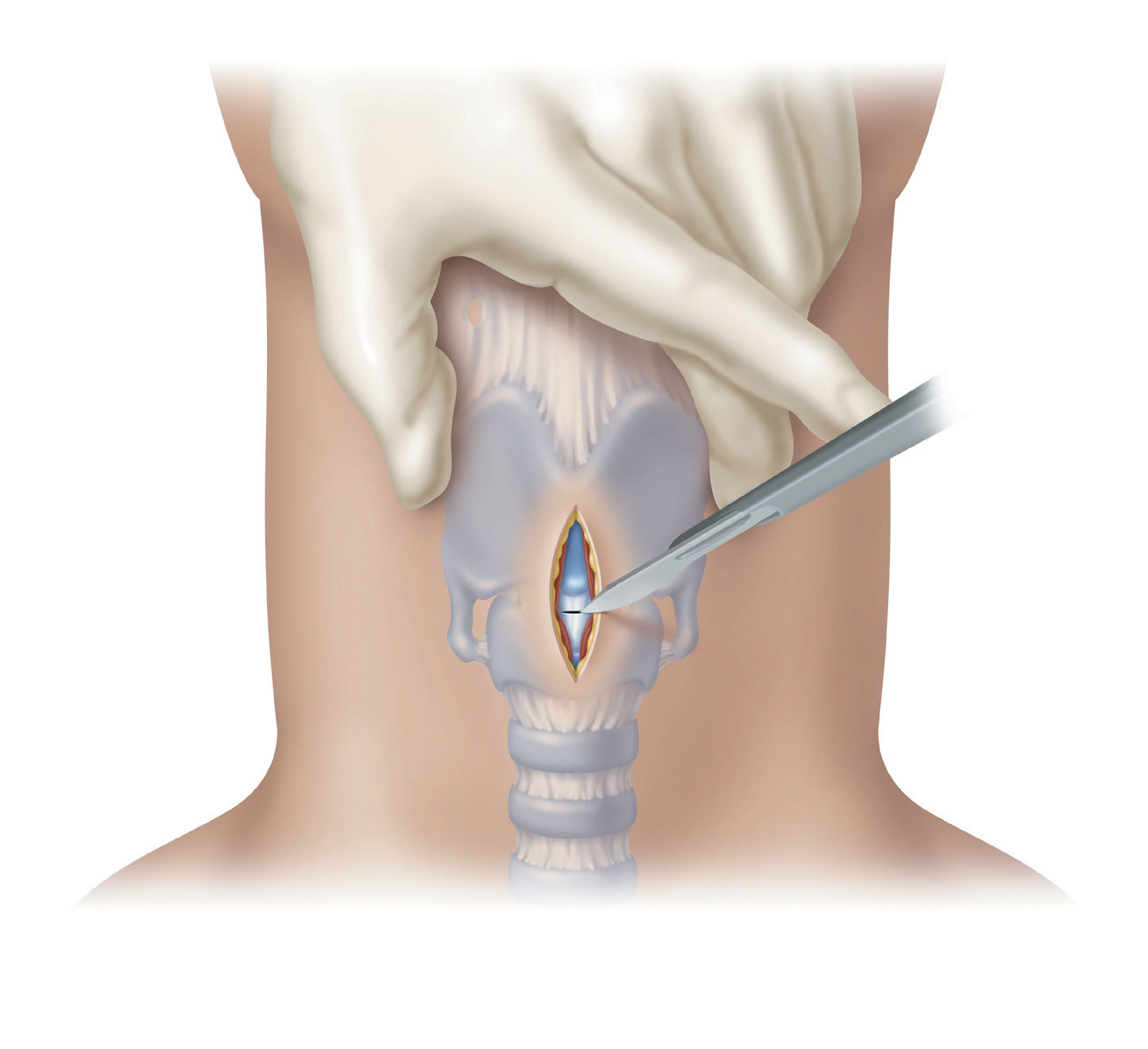 Cook Medical's Surgical Melker Expands Cricothyrotomy Offering for ‘Cannot Intubate, Cannot Ventilate’ Scenarios