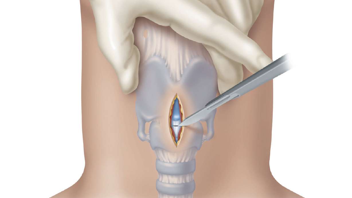 Cook Medical's Surgical Melker Expands Cricothyrotomy Offering for ‘Cannot Intubate, Cannot Ventilate’ Scenarios
