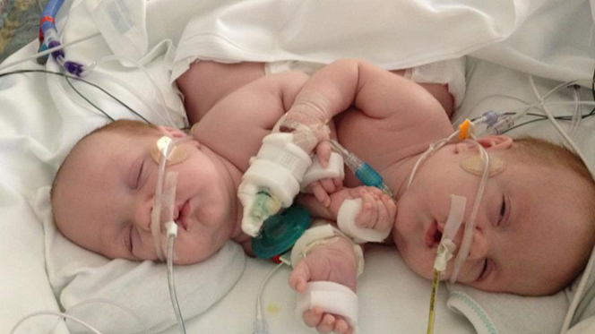 Formerly conjoined twins thriving, released from hospital