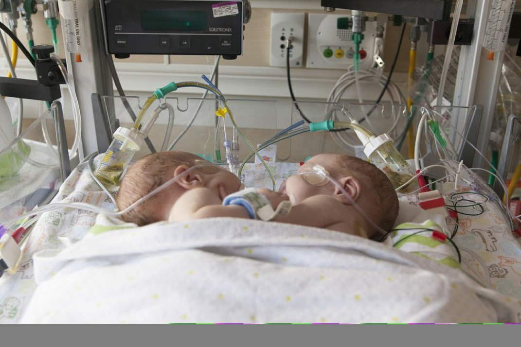 "They were conjoined from the xyphoid process
(just below the sternum, or breastbone) to
approximately the belly button. They shared
internal organs as well - primarily the liver
and the small bowels (small intestines).
Conjoined twins have a very limited chance of
survival." -Jenni Enzell