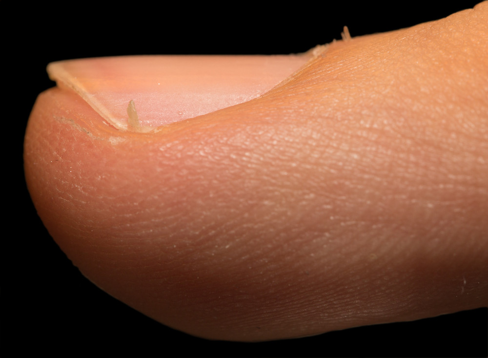 Hangnail hangnail
