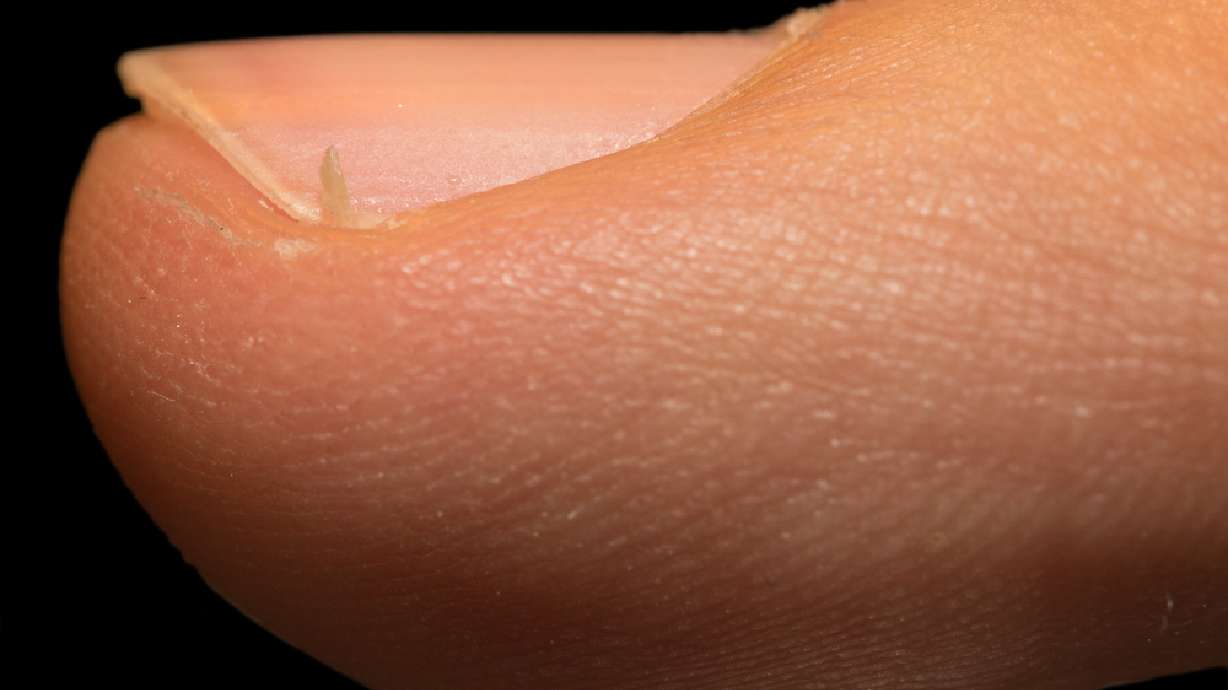How to treat irritating (and sometimes dangerous) hangnails | KSL.com