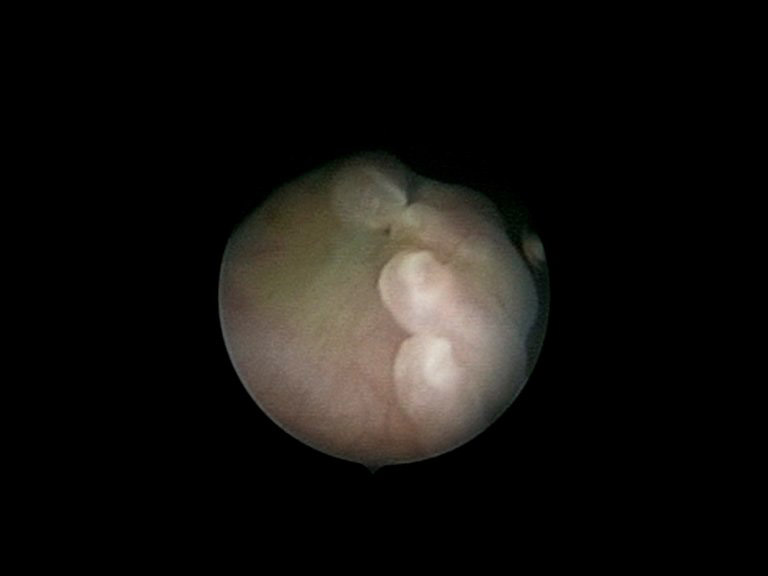 Tiny robotic arm could operate on babies in the womb