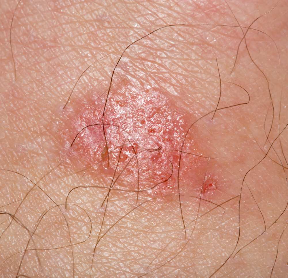 Ringworm: how to identify, treat and (hopefully) avoid it