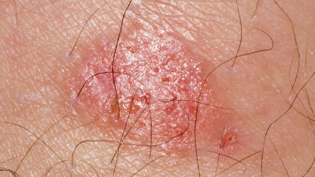 Ringworm: how to identify, treat and (hopefully) avoid it | KSL.com