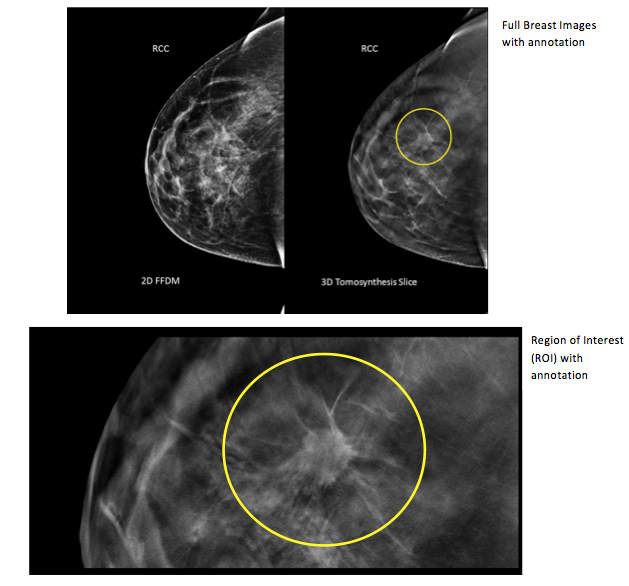 3-D mammogram scans may find more breast cancer