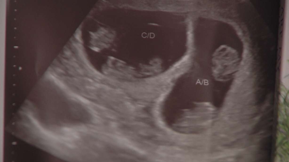 Sonogram image of the Gardner's two sets of identical twins.