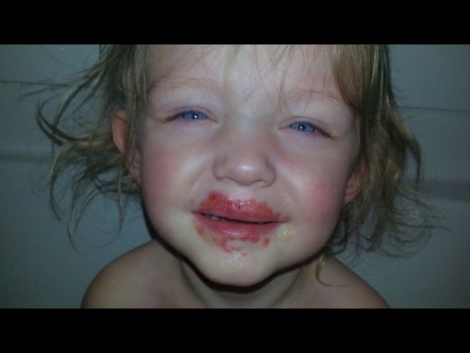 Aumentan los casos de niños afectados con la enfermedad de 'manos, pies y boca' en UT