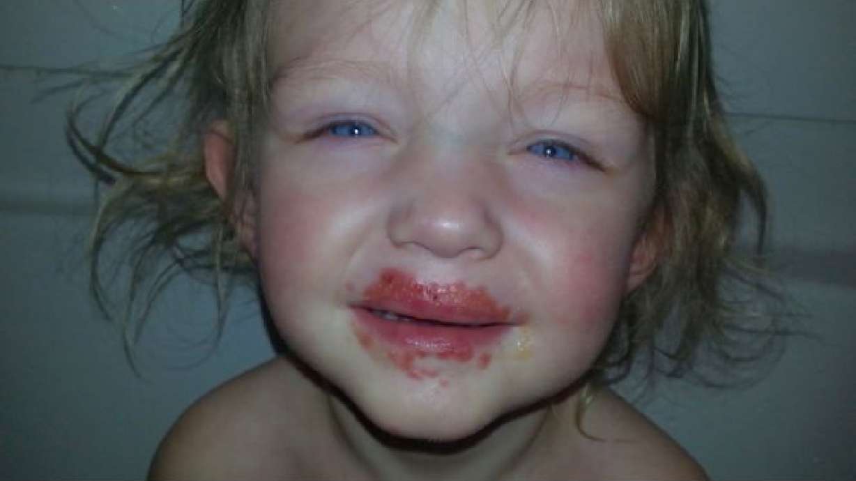 Aumentan los casos de niños afectados con la enfermedad de 'manos, pies y boca' en UT