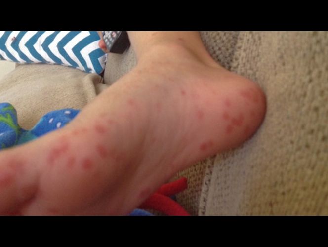 Aumentan los casos de niños afectados con la enfermedad de 'manos, pies y boca' en UT