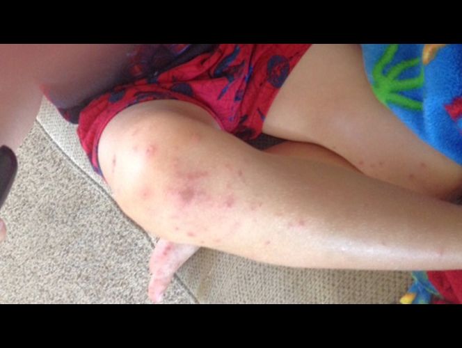 Aumentan los casos de niños afectados con la enfermedad de 'manos, pies y boca' en UT