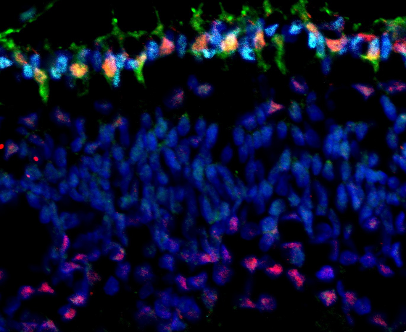 How a Single, Genetic Change Causes Retinal Tumors in Young Children