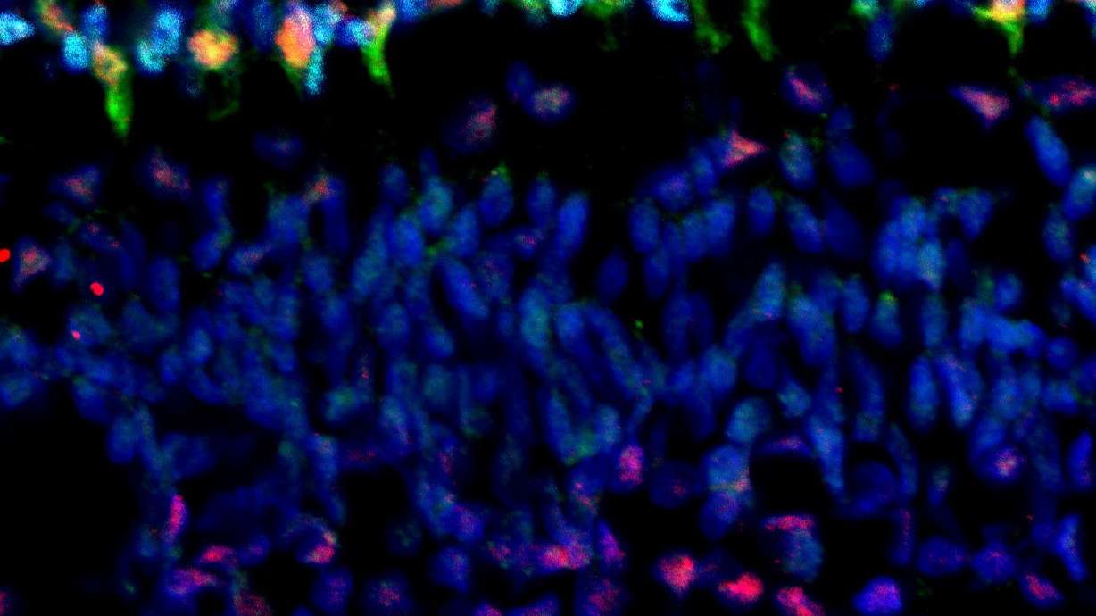 How a Single, Genetic Change Causes Retinal Tumors in Young Children