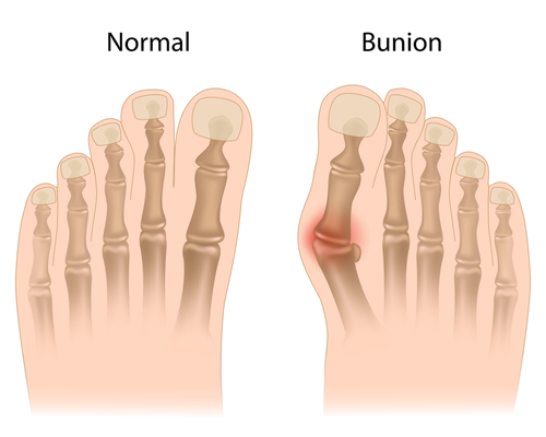 4 things that may be causing those painful bunions