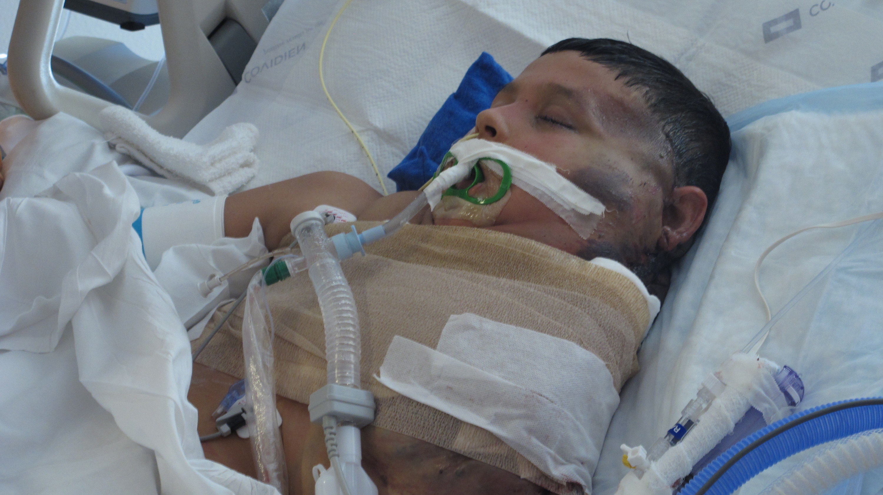 Mexican boy who had massive tumor recovering