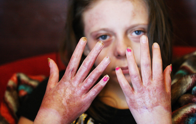 Rachel Lukasik shows her burned hands at the newly opened University Health Care Patient and Family Housing Hotel in Salt Lake City Wednesday, Nov. 26, 2014. Lukasik is recovering from burns from an airplane crash. The new lodging accommodations give patients the options of a long-term suite or guest room for them or their family. (Jeffrey D. Allred, Deseret News)