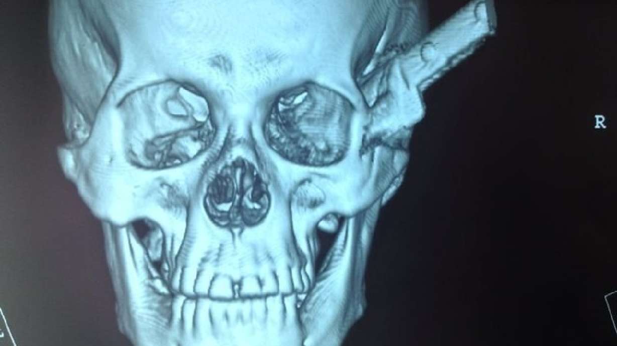 Brazilian man survives brawl that left knife stuck in head for hours