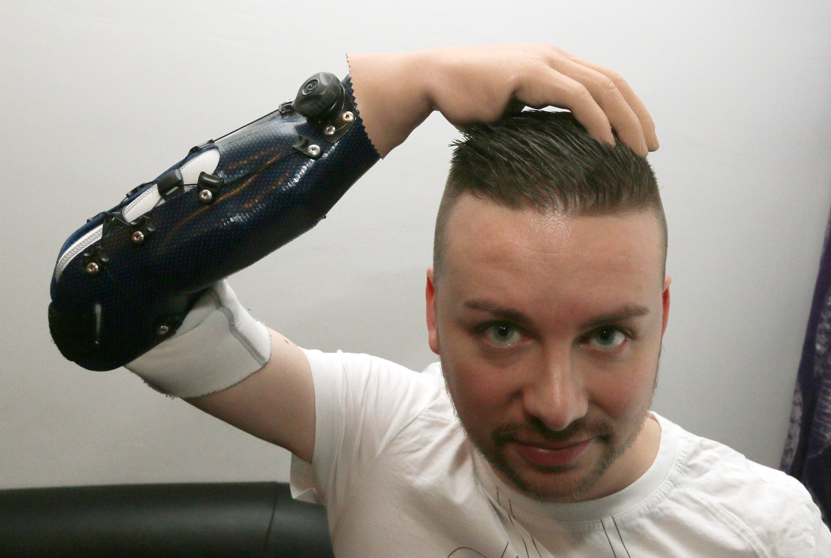 3 men 1st to get reconstructed bionic hands after amputation