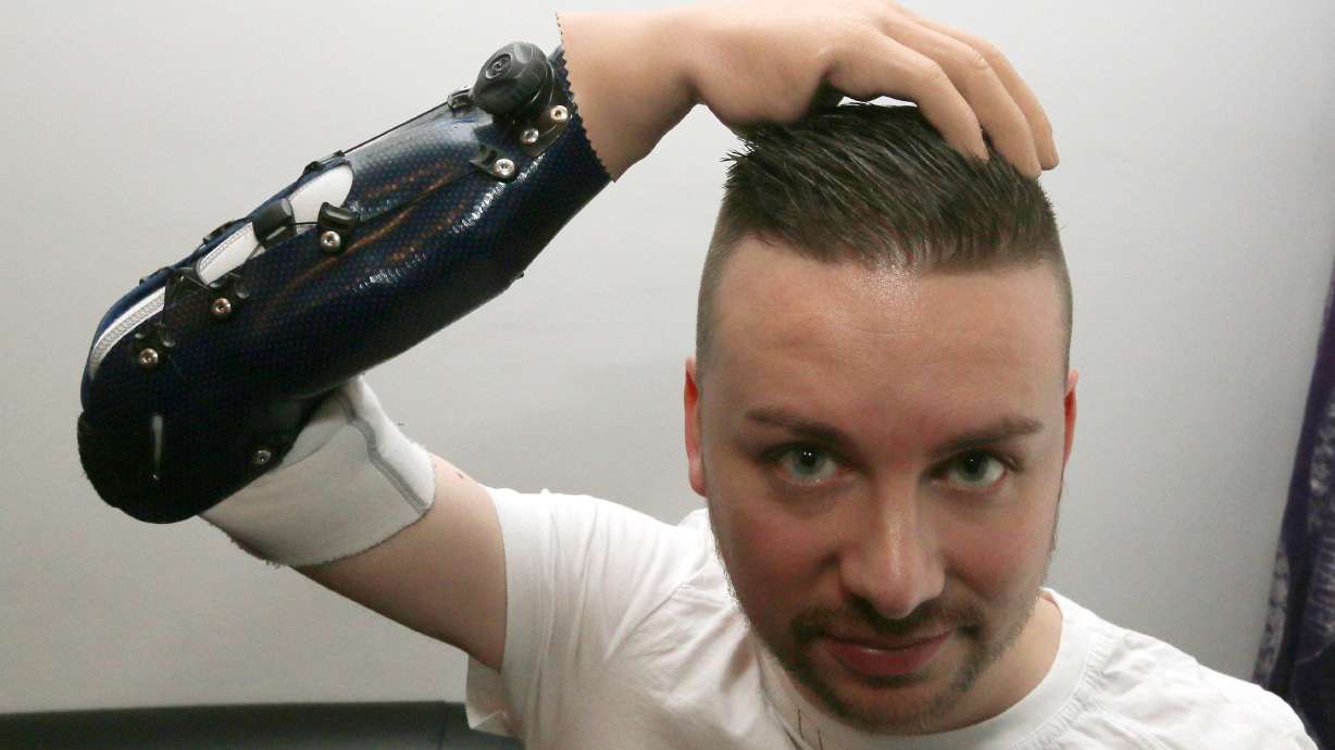 3 men 1st to get reconstructed bionic hands after amputation