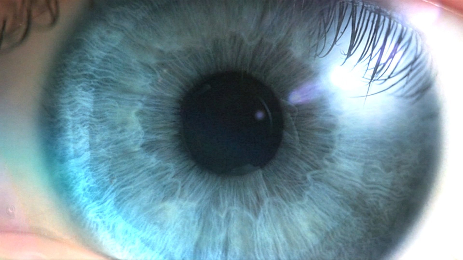 Laser procedure can turn brown eyes blue