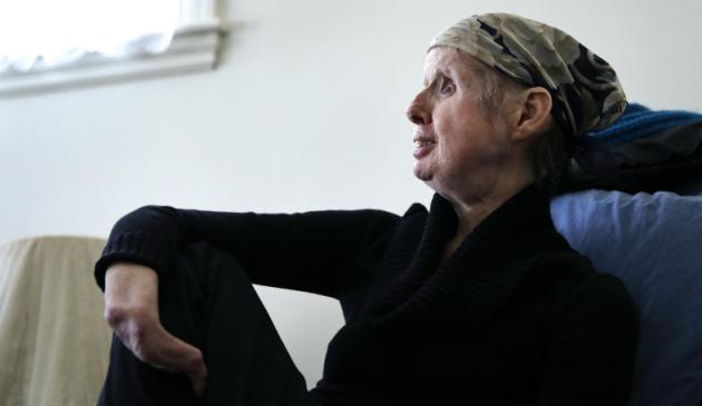 Trasplante de rostro