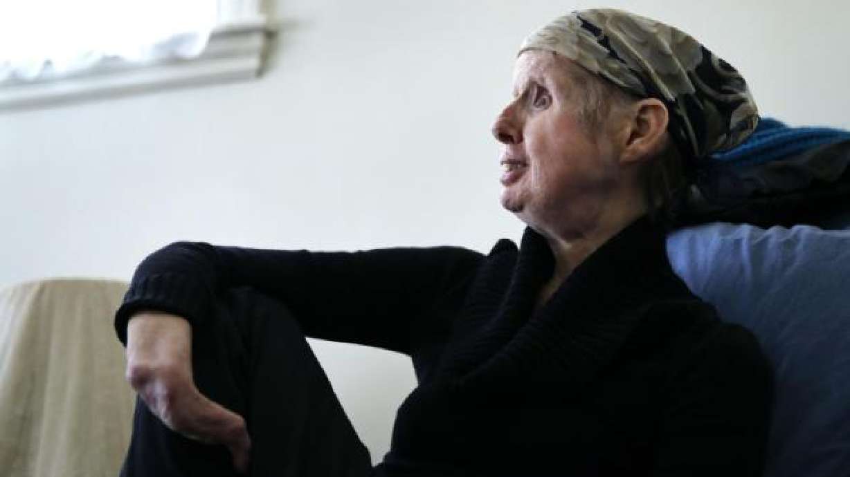 Trasplante de rostro