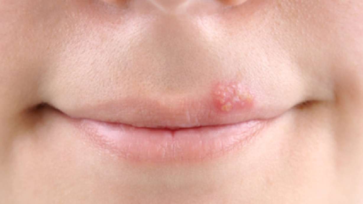 Remedios caseros para las verrugas, quemaduras de sol, herpes labial y el olor de los pies