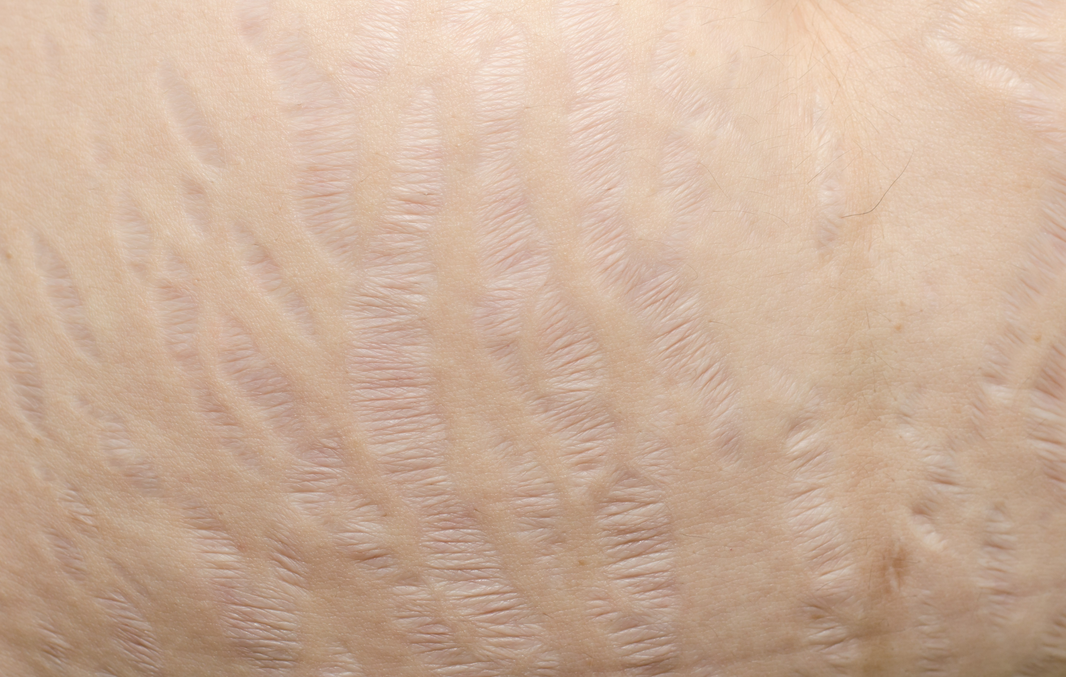 Love Your Lines: stretch marks go viral in support of women