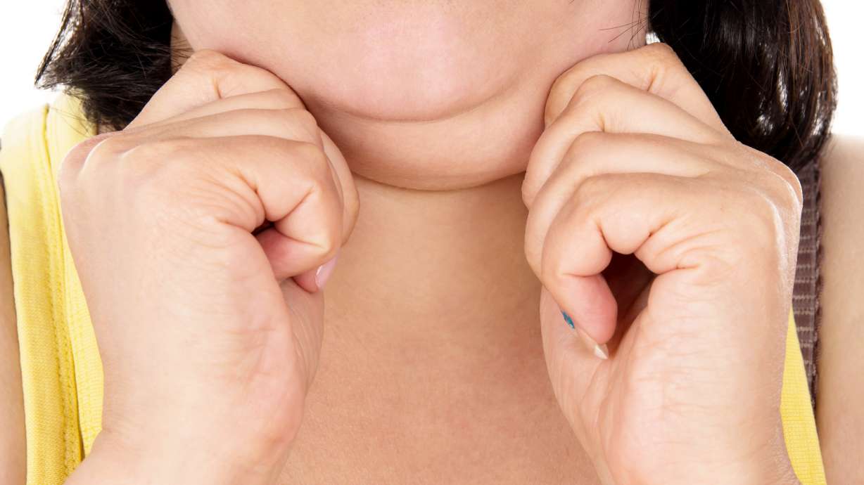 FDA approves new drug to dissolve chin fat