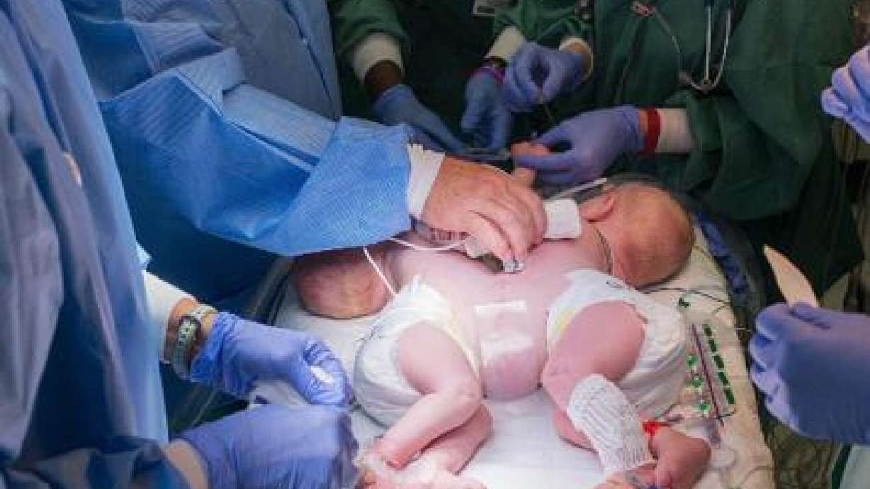 Separan exitosamente a siameses de cinco meses