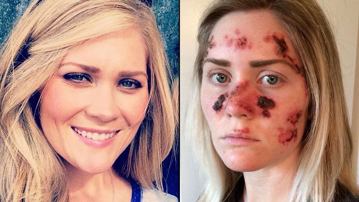 Frequent tanner shares grisly skin-cancer selfie