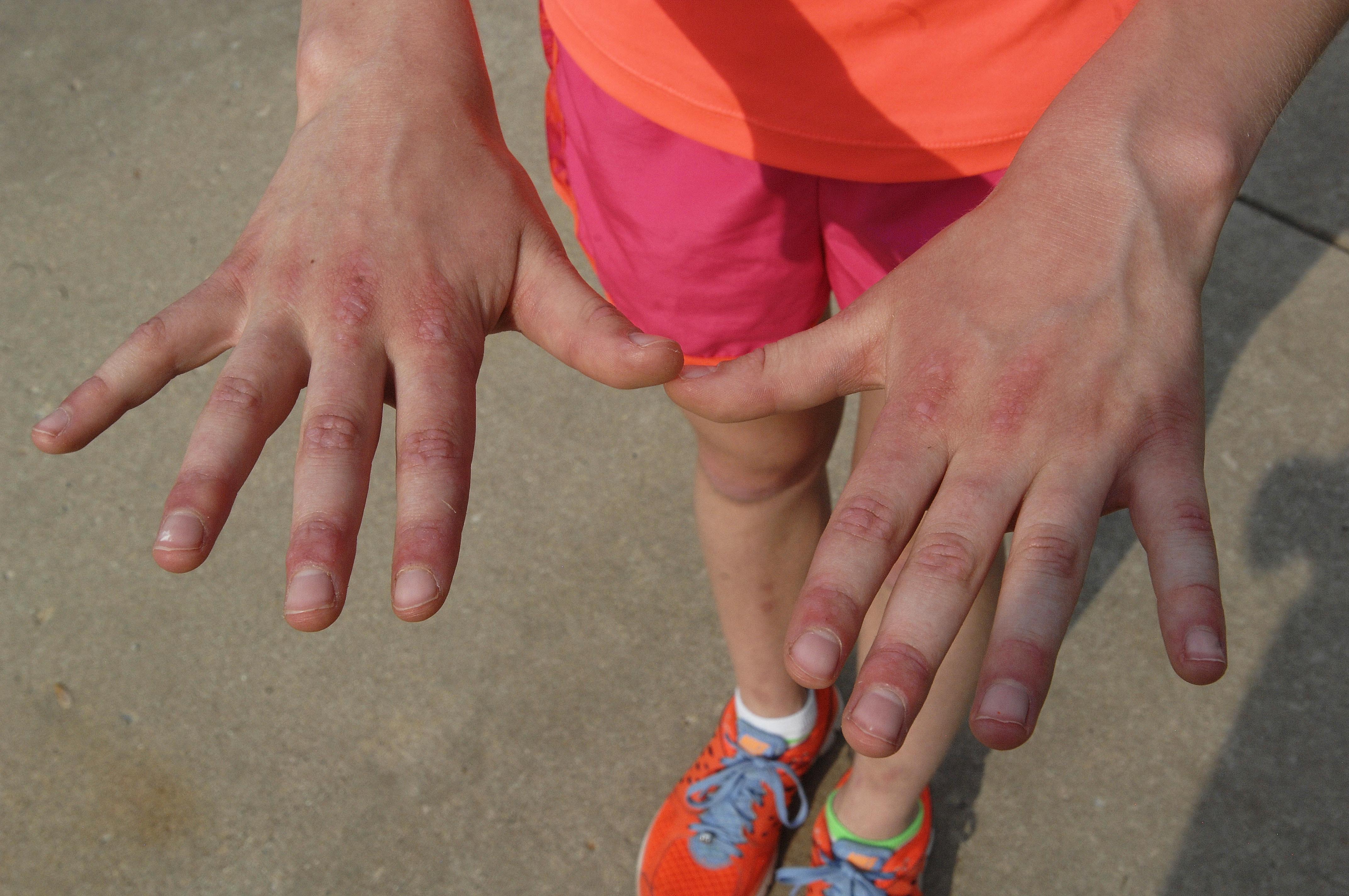 EXCHANGE: Girl with rare disease moves to help save her body