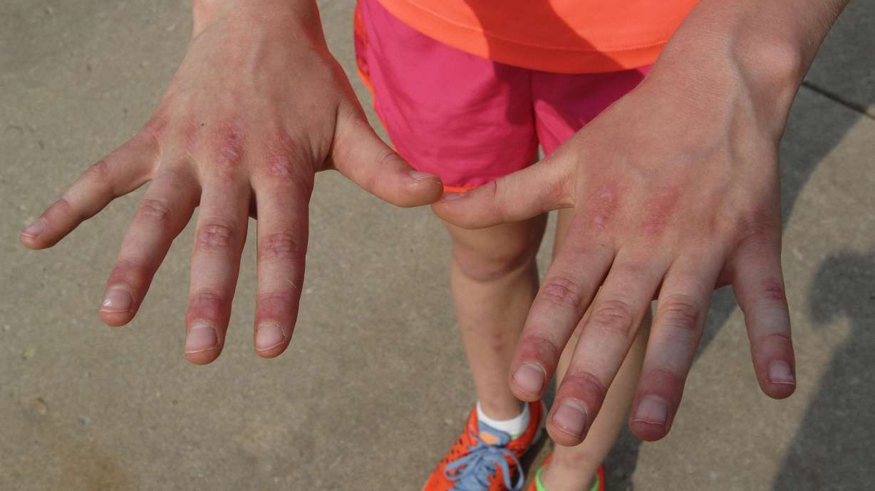 EXCHANGE: Girl with rare disease moves to help save her body