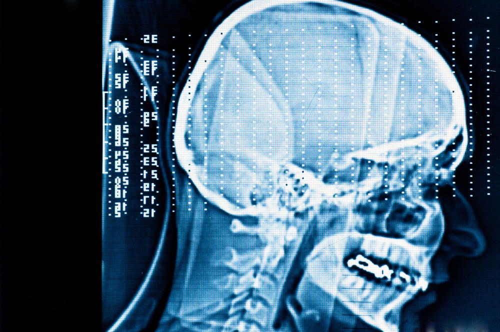 Siri of the future could be implanted in your brain