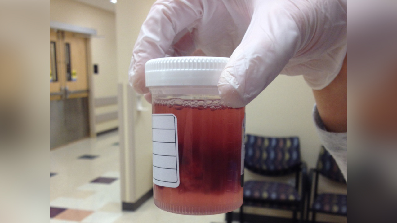 Large tonsils earn local man, doctor Guinness World record