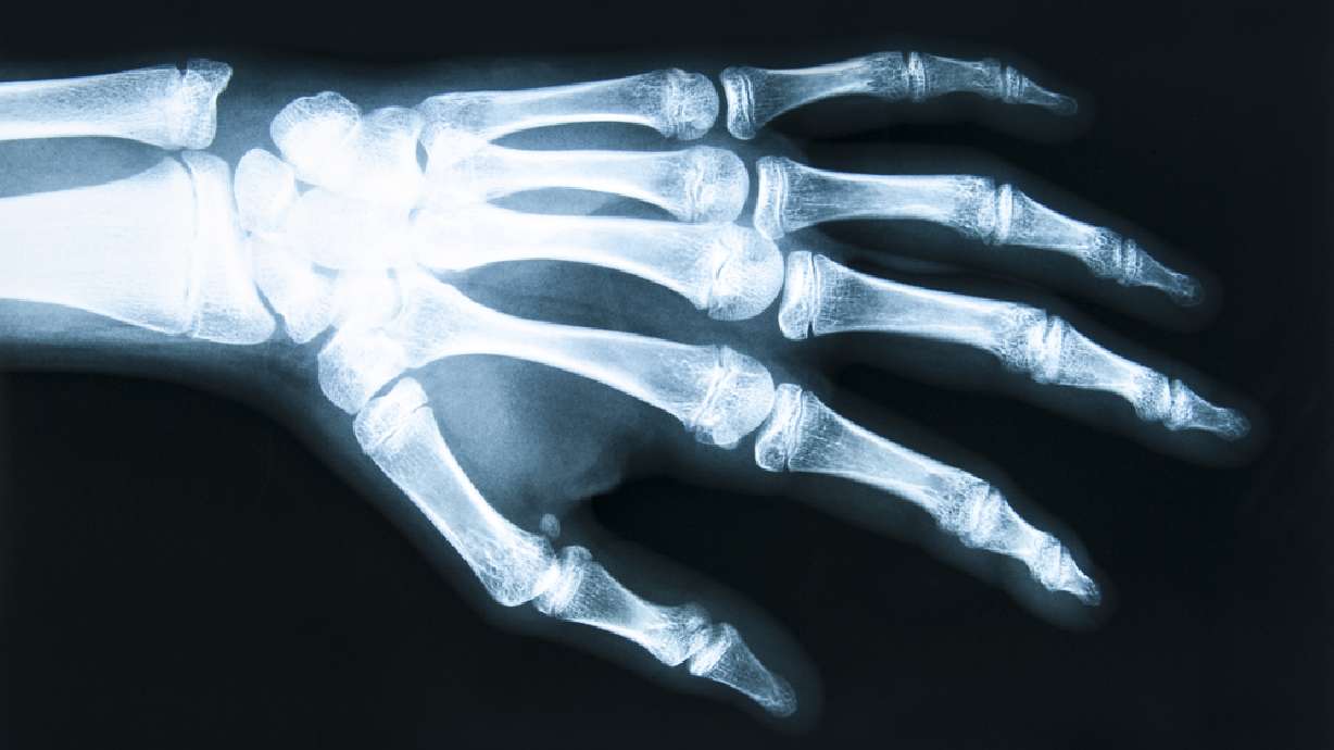 Doctors in China save man's severed hand by grafting it to his leg